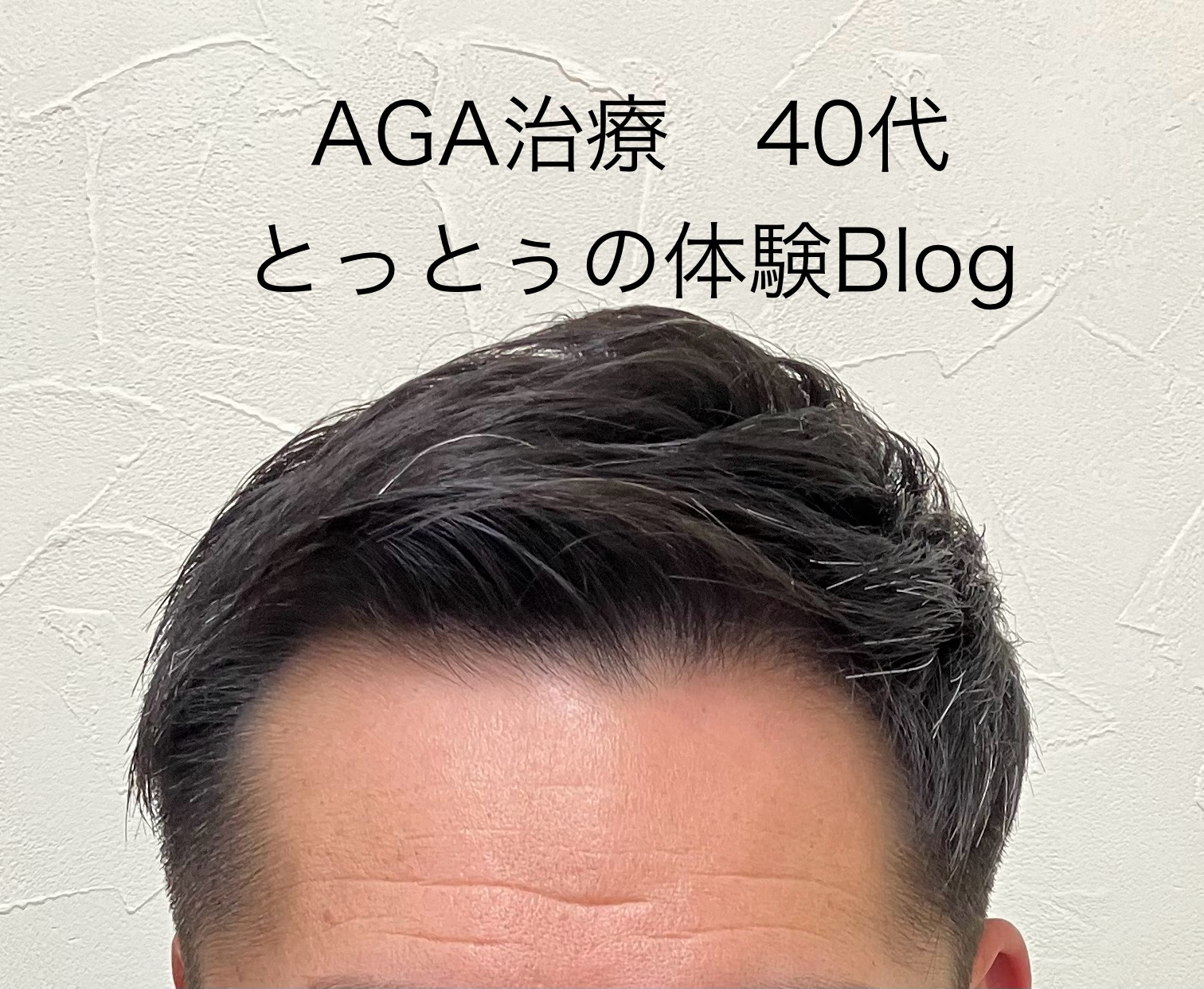 AGA治療40代とっとぅの体験Blog